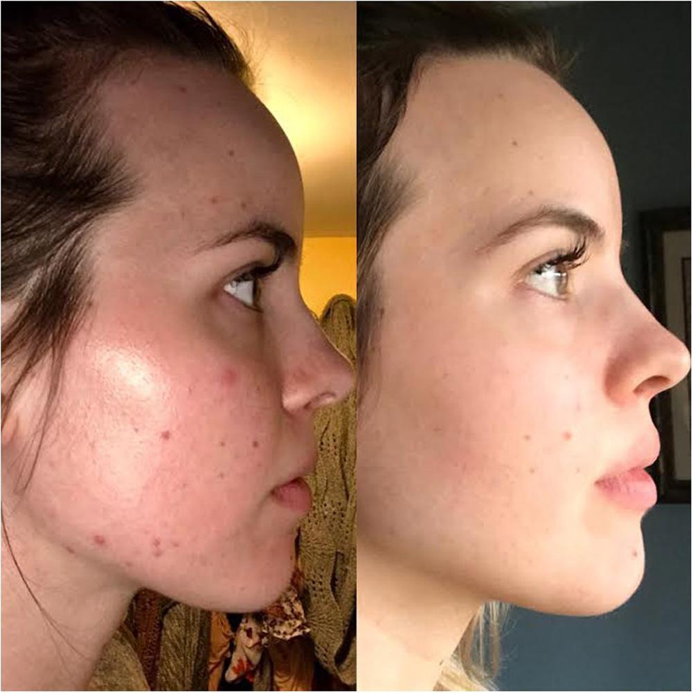 The Ordinary Azelaic Acid Suspension 10%